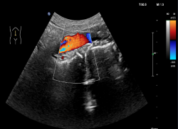 Ultraschall-Screening-Aufnahme der Bauchaorta