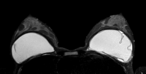 Aufnahme eines Brust-MRT's mit Implantaten