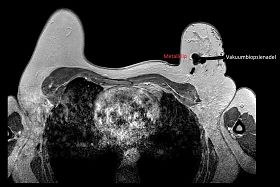 Aufnahme einer MRT-Vakuumbiopsie der Brust